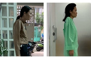 Căn bệnh khiến cô gái 30 tuổi bị còng như 60 tuổi