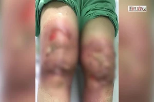 Video: Rước họa khi tự đắp lá chữa đau khớp gối