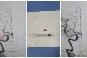 Kịp thời cứu cụ ông 84 tuổi nhồi máu não nguy kịch