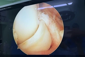 Rách sụn chêm dạng quai xách khi đá banh, đừng chủ quan!