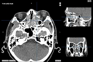 Phẫu thuật thành công ca u nhầy xoang sàng xâm lấn hốc mắt