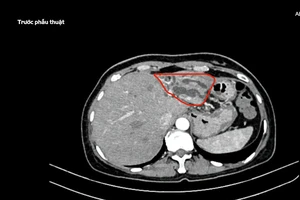  Người phụ nữ nhiễm trùng đường mật do sỏi, phải cắt bỏ một phần gan