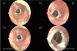 Lồi xương ống tai khiến người phụ nữ suy giảm thính lực