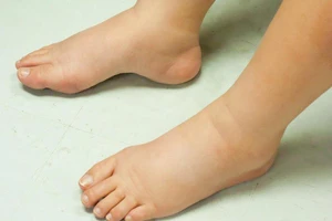 2 trẻ nhập viện vì phù bất thường, phát hiện viêm cầu thận cấp