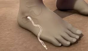 Bệnh giun rồng là gì, có nguy hiểm không?