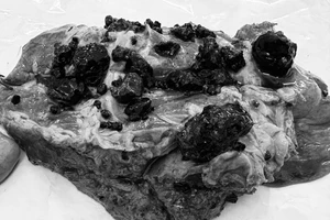 Đau bụng kéo dài, bệnh nhân bất ngờ vì ổ sỏi đường mật nằm sâu trong gan