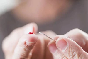 Chích máu đầu ngón tay có thể chữa đột quỵ?