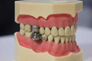 Các nhà nghiên cứu New Zealand đã tạo ra một thiết bị giảm cân sử dụng nam châm “khóa hàm" bệnh nhân.