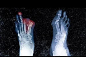 Nam sinh viên được chẩn đoán mắc vi khuẩn neisseria meningitidis và phải cắt bỏ chân và ngón tay của mình.