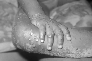 Đậu mùa khỉ là một căn bệnh đặc hữu ở châu Phi, nay đã bùng phát tại một số quốc gia ở châu Âu.