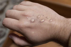 Bệnh nhân mắc bệnh đậu mùa khỉ bị phát ban trên tay. 