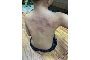 Hải Phòng: Kết luận vụ việc cháu bé nghi bị bạo hành tại trường mầm non An Dương