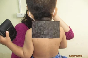 Bé trai mắc bệnh hiếm 500.000 trẻ mới có một ca