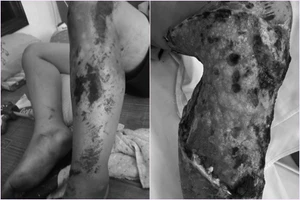 Đắp lá chữa bầm tím, bệnh nhi suýt mất chân 