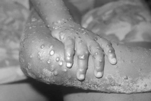 TP.HCM ghi nhận ca mắc đậu mùa khỉ đầu tiên, Bộ Y tế ra công văn khẩn 