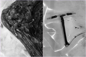 Bé gái chào đời cùng với 1 chiếc vòng tránh thai nằm ở rìa bánh nhau 