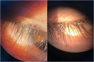 Gần 100 con rận làm tổ trên mi mắt người đàn ông 