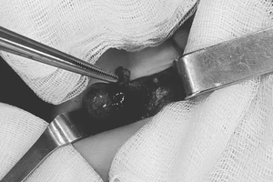 Bé 10 tháng tuổi phải cắt tinh hoàn do bị xoắn hoại tử 