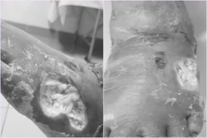 Hoại tử chân do dùng thuốc nam chữa tiểu đường