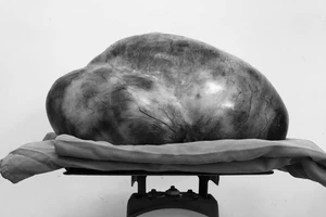 Cô gái mang khối u khủng 13 kg 