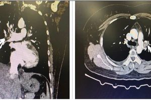 Uống 12-15 viên thuốc tránh thai khẩn cấp mỗi tháng, người phụ nữ bị nhồi máu phổi 