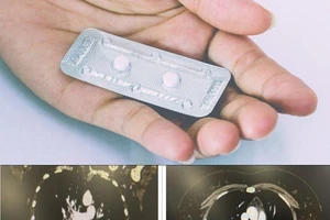 Từ vụ cấp cứu do uống 12-15 viên tránh thai khẩn cấp, bác sĩ nói gì?