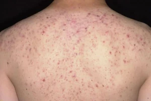 Đến spa tẩy mụn trứng cá ở lưng, người phụ nữ suýt mất mạng 