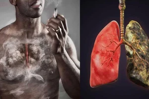 Bác sĩ Bệnh viện K chỉ rõ 12 dấu hiệu cảnh báo ung thư phổi 