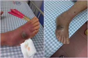Chuột cắn hoại tử chân cụ bà