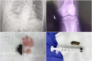 Báo động đỏ liên viện cứu thanh niên bị thủng tim do tai nạn