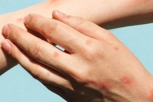 Ca nghi mắc đậu mùa khỉ ở Đắk Lắk có kết quả xét nghiệm âm tính 