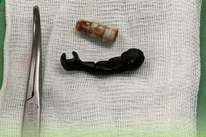 Gắp đầu bút và tay siêu nhân trong vùng kín bé gái 5 tuổi 