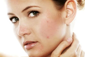 8 thực phẩm giúp trị mụn từ bên trong hiệu quả nhất