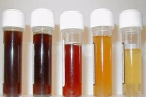 Màu sắc nước tiểu cảnh báo vấn đề sức khỏe gì?