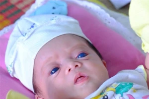 Lý giải căn bệnh kỳ lạ của 'thiên thần mắt xanh'