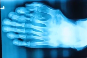 Chàng trai có 9 ngón trên một bàn chân, nghĩ là phúc của Phật