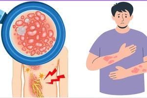 Vì sao người trên 50 tuổi có bệnh nền dễ gặp biến chứng do zona?