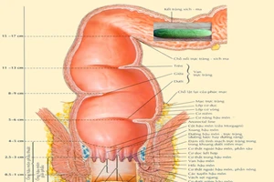 Nam bệnh nhân bị lọt cả quả dưa leo vào bụng