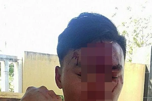 Cán bộ kiểm lâm bị 2 phụ nữ đánh gãy xương mũi