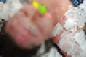 Sự thật về người phụ nữ bỏng nặng do làm đẹp bằng cồn nhân sâm