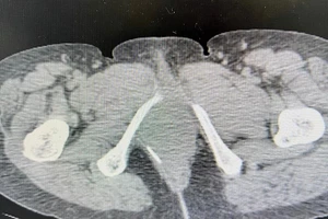 Cứu sống một nữ bệnh nhân nuốt tăm xỉa răng thủng trực tràng