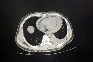 Cứu thợ hồ bị đâm thủng tim, thủng phổi 