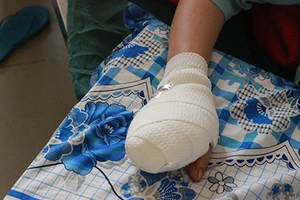 Một phụ nữ bị máy xay thịt nghiền nát bốn ngón tay