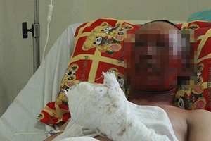 Nổ lò luyện thép, hai công nhân bỏng nặng