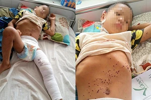 Nhặt kíp nổ của cha chơi, bé trai 8 tuổi suýt mất mạng