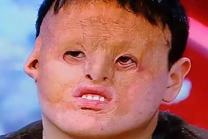 Lấy mảng lớn da bụng ghép lên mặt