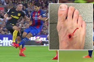 Suarez chơi xấu khiến chân đối thủ… lủng lỗ