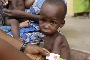 Bác sĩ chăm sóc một trẻ em suy dinh dưỡng tại trại tị nạn ở thành phố Yola, Nigeria vào ngày 3-5-2015. Ảnh: AP