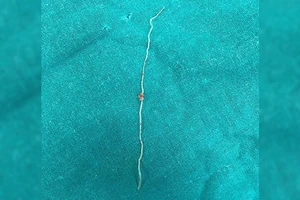 Tìm thấy giun 12 cm từ má của người phụ nữ bị muỗi đốt