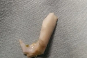 Cứu trẻ một tuổi bị hóc xương khi ăn cháo